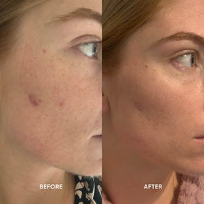 Before and after images from use of ManukaRx  Rejuvenating Mānuka Oil Exfoliant